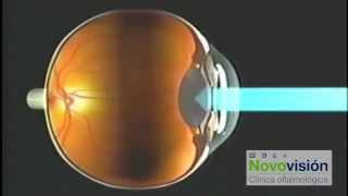 TRATAMIENTO CON ANILLO INTRACORNEAL - CLÍNICAS NOVOVISIÓN