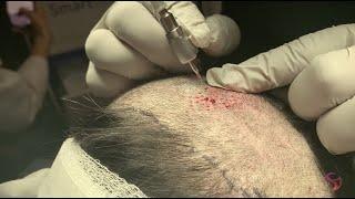 SmartGraft Hair Restoration