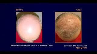 Corridor Hair Restoration featuring NeoGraft® Trusted Hair Transplant Treatment in Coralville, IA