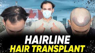 Hair Transplant in London | Best Results & Cost of Hair Transplant in London