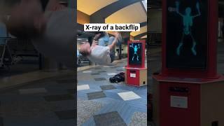 BACKFLIP IN HOSPITAL 