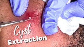 Ingrown Hair and Cyst Extraction