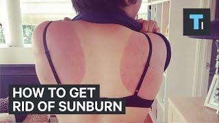 How to get rid of sunburn