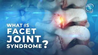 What is Facet Joint Syndrome?