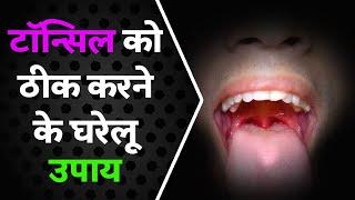 सर्दियों में टॉन्सिल को ठीक करने के घरेलू उपाय | Effective Remedies to Cure Tonsil During Winter