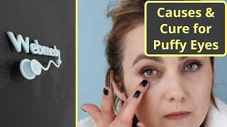 What causes Puffy Eyes and How to Reduce Puffiness in Eyes?