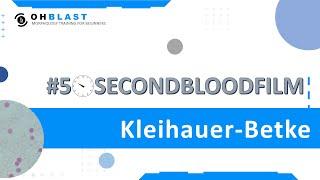 #50SecondBloodFilm​: Kleihauer-Betke test