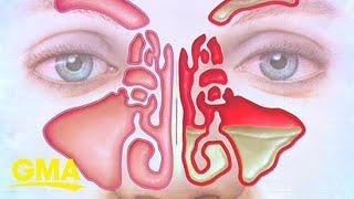 How to treat sinus infection symptoms at home