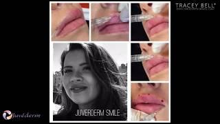 Juvederm Smile - Lips Fillers Uk