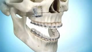 ‪Upper Jaw Advancement Surgery‬‏