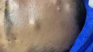 FOREHEAD ACNE (Large Oozing Pustules |Blackhead Removal)