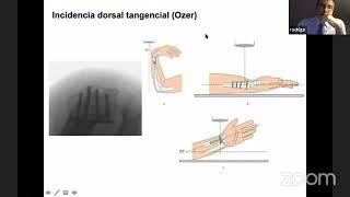 124-Usa la radioscopia en el tratamiento quirúrgico en las  fracturas de radio distal?