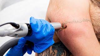 How does laser tattoo removal work?