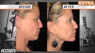 ExtraTV Featuring Fractora RF HD