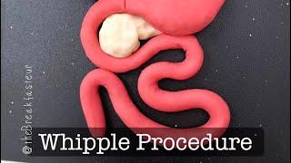 Playdough Surgery  - Pylorus-Preserving Pancreaticoduodenectomy AKA Whipple Procedure - Part I