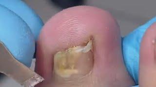 Nail almost go through toe