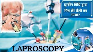 Laproscopy surgery full information  दूरबीन द्वारा पित्त  की थैली  केसे निकलते हैं #laproscopy