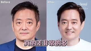 【五合一隱痕眼袋手術】讓不太代言的知名演員也強烈推薦的減齡秘訣