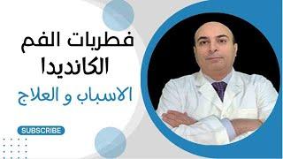 علاج فطريات الفم (الكانديدا) و اهم اسبابها