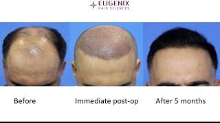 Best Hair Transplant Clinic in India @EugenixHairSciencesofficial By Expert Hair Restoration Surgeon