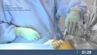 PMT sEEG Implant Surgical Procedure