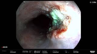 Esophageal cancer/ рак пищевода