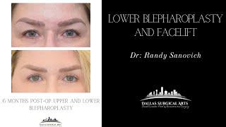 A Look Inside the OR: Upper and Lower Blepharoplasty with Dr. Sanovich