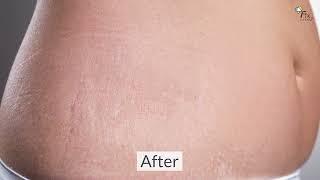 Stretch Mark Removal Cream| Fixderma- Strallium Stretch Marks Cream