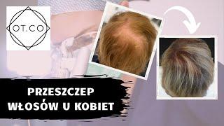 Przeszczep włosów u kobiet - OT.CO Clinic