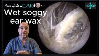 Wet soggy ear wax - Episode 118 #ear #earwax #earwaxremoval #earcleaning #earwaxclinic