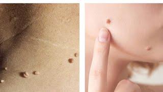 How to remove skin tags at home |از بین بردن خال های گوشتی جلد در خانه