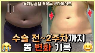 지방흡입리얼후기: 당일부터 2주차모습까지!