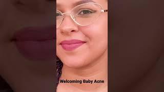 Welcoming Baby Acne