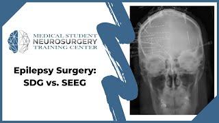 Epilepsy Surgery: SDG vs. SEEG