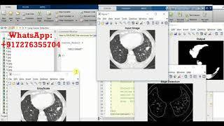 Lung Cancer Detection Using Image Processing Matlab Project Source Code