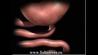 Лапароскопическое шунтирование желудка, gastric bypass