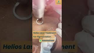 Helios laser treatment for Pigmentation | Removes Dark Spots & Blemishes at @skinqure  | Delhi