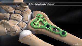 Distal Radius Fracture Repair