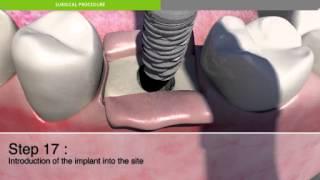 Surgical procedure for placement of a dental implant