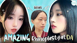 [Plastic Surgery Korea] Amazing Rhinoplasty Results from DA!