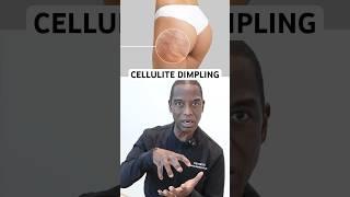 89% of Women have or will have Cellulite