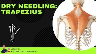 Dry Needling: Trapezius