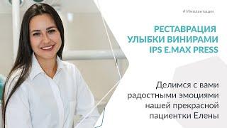 Эстетическая реставрация улыбки ультратонкими винирами.