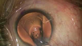 Implantable Collamer Lens(ICL) surgery