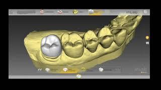 Single tooth crown in 10 minutes