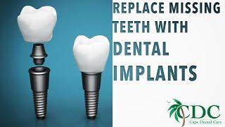 Dental Implants - The Best Choice for Missing Teeth