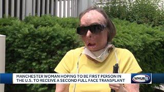 Face transplant recipient needs 2nd transplant