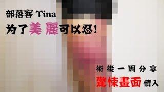 TINA術後一周心得分享~內有驚悚畫面慎入