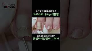 동그랗게 말려버린 통증 내성발톱!! 파도파도 나오는 이물질!? #레푸스 #일산레푸스 #내성발톱 #무좀발톱 #ingrown_toenail #일산내성발톱 #일산무좀발톱 #발톱