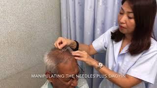 Zhu's Scalp Acupuncture for lower limb weakness, numbness and pain.